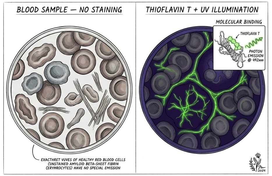 Two-panel illustration: left panel shows blood sample with no staining โ healthy red blood cells and unstained amyloid beta-sheet fibrin structures. Right panel shows the same sample under Thioflavin T staining and UV illumination โ amyloid fibrils emit bright green fluorescence at 492nm while healthy cells remain dark. Inset shows molecular binding mechanism.